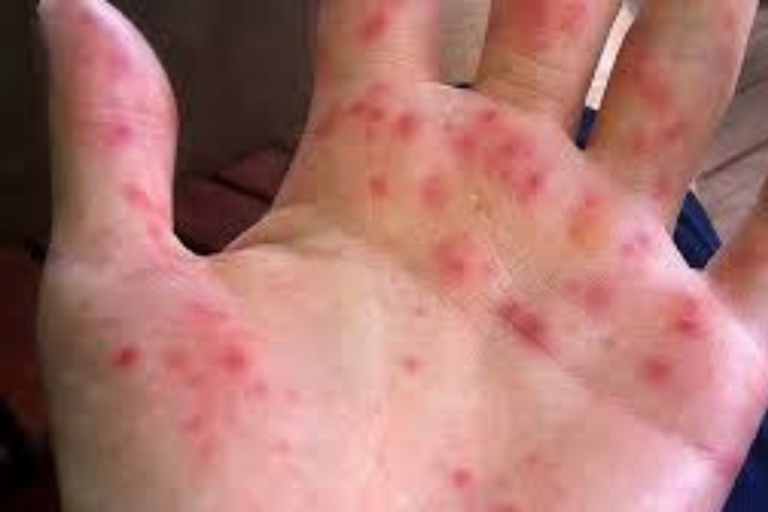 زيمبابوي تفرض الحجر الصحي على بيتبريدج بعد تفشي الحمى القلاعية