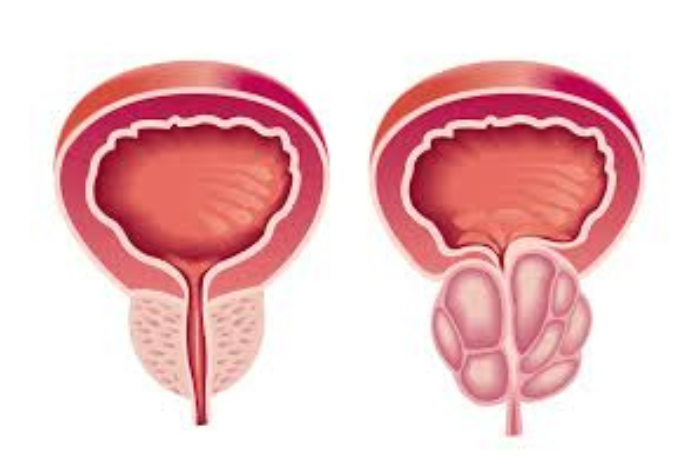 دراسة سرطان البروستاتا منخفض الدرجة قد يخفي خطورة أعلى مما يعتقد