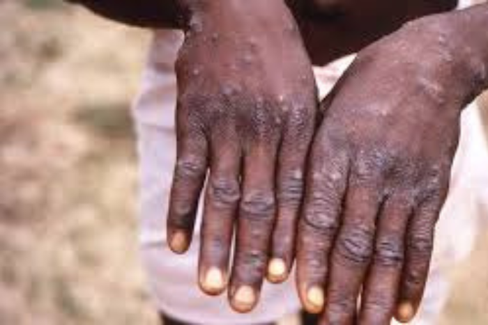 رتفاع عدد حالات جدري القردة في السنغال إلى أربع حالات